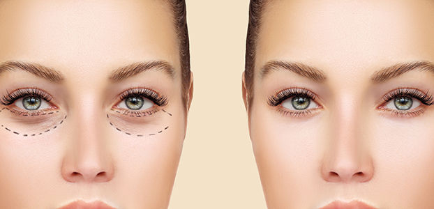 blepharoplastie-chirurgien-lyon-ecully
