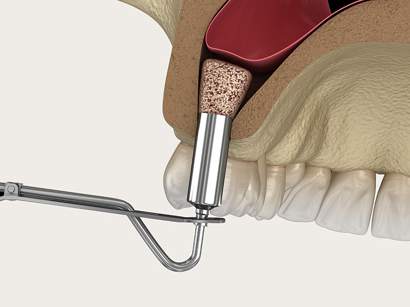 sinus-lift chirurgien maxillo-facial esthetique lyon